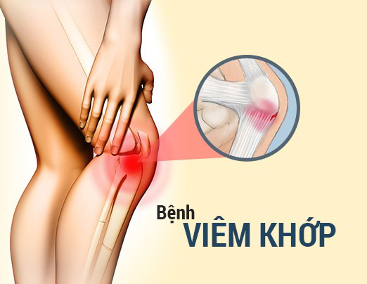 Tác dụng của Gen S với bệnh xương khớp