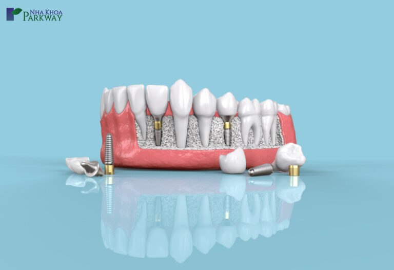 Nên trồng răng implant ở độ tuổi nào là phù hợp nhất?
