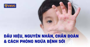 Tiếp tục triển khai các biện pháp phòng, chống bệnh Sởi